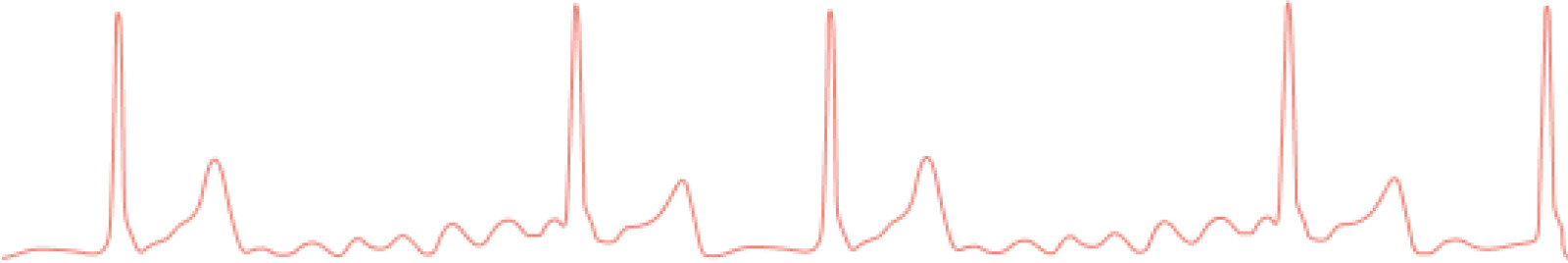 Heartbeat in afib